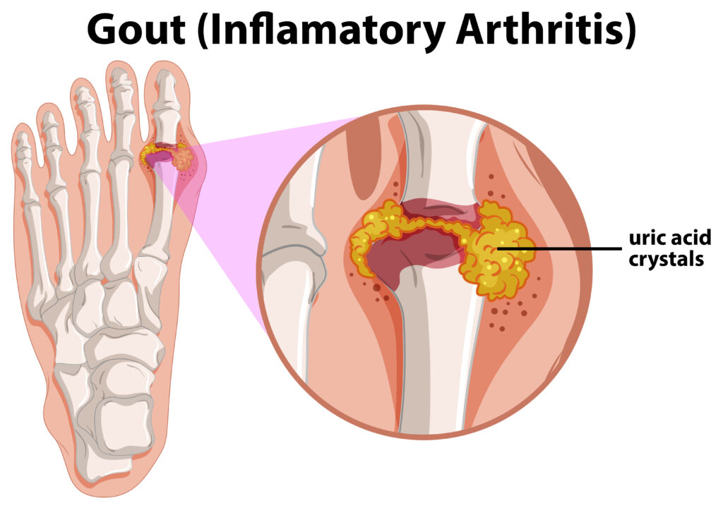 10 Ways to Lower Uric Acid Naturally: Evidence-Based Strategies for Gout Management